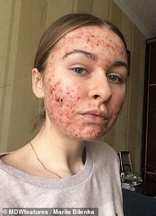 Woman, 22, shares candid selfies of severe acne which suddenly broke out across her entire face ...