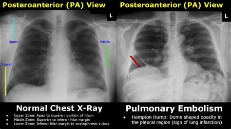 Chest X-Ray Lung Normal Vs Abnormal Image Appearances Part 2 | Pleural ...