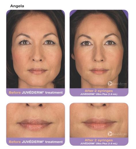 Juvederm Before and After Pictures - Velvet Effect Lasers