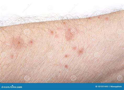 Skin Disease Rash on a Man Arm Stock Image - Image of blisters, itchy: 181551443