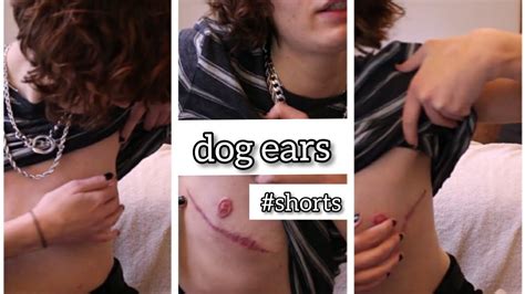 Dog Ears After Top Surgery: What Are They? | #Shorts - YouTube