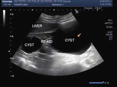 Renal Cyst Ultrasound