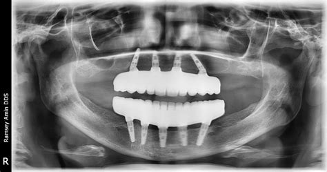 The All on 4 Dental Implants Process