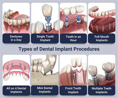 Dental Implants Procedures | NYC Dental Implants Center