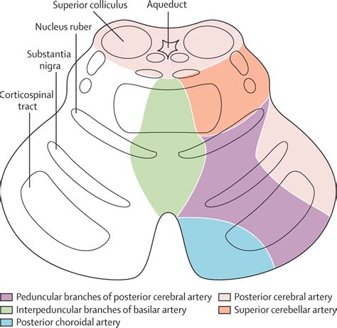 Basilar artery occlusion - The Lancet Neurology