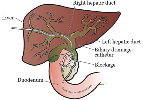 Internal External Biliary Drainage Catheter Best Drain Photos | My XXX ...