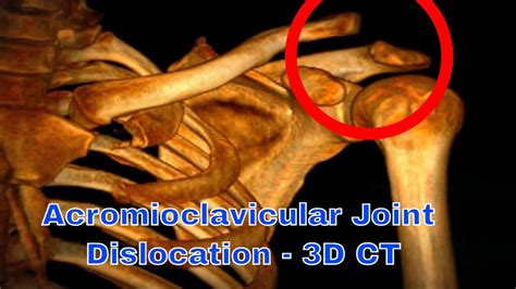 Acromioclavicular joint dislocation - Shoulder CT and 3D CT - YouTube