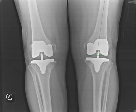 joint care foundation: Bilateral Knee Joint Replacement