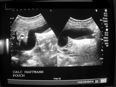 WK 3 Gallbladder Hartmann's pouch | Abd Ultrasound 100 Mod 2 | Ultrasound, Crop tops, Pouch