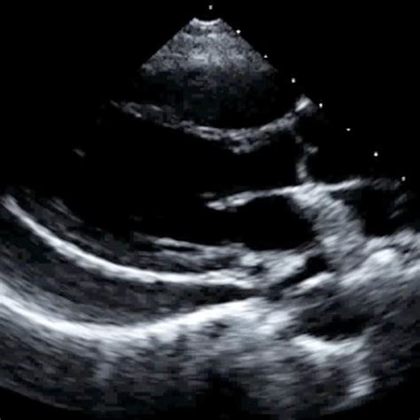 Pericardiocentesis Procedure - Ultrasound-Guided Technique