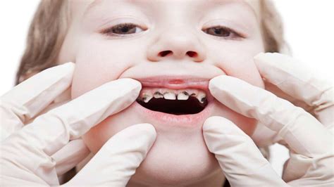 Treatment Options When Your Child Has Severe Tooth Decay