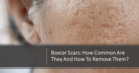 Boxcar Scars: How Common Are They and How to Remove Them? | Dream Plastic Surgery