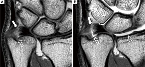 Tfcc Tear Mri - Goimages Inc