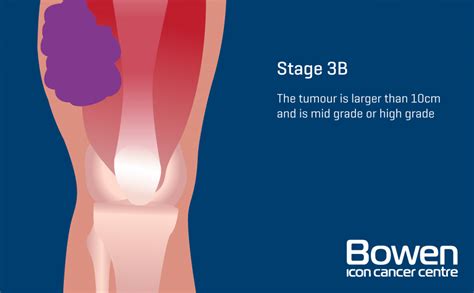 What is Soft Tissue Sarcoma? Soft Tissue Sarcoma Explained — Bowen Icon Cancer Centre