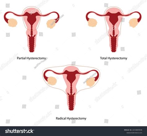 Hysteroscopy Surgery Type Diferent Types Uterus Stock Vector (Royalty Free) 2233805939 ...