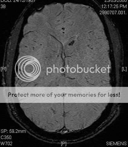 Treatments for a Left Caudate lesion? - Brain Health - LONGECITY