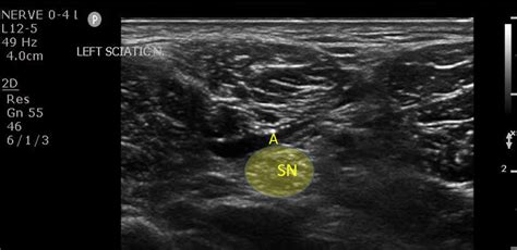 Popliteal Sciatic Nerve Block | EM Ultrasound Section