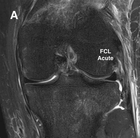 FCL Injury | Lateral Collateral Ligament LCL Tear | Minnesota Knee Specialist