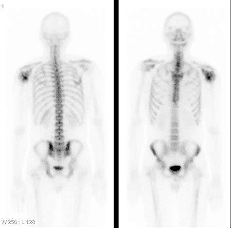 Chondrosarcoma - Causes, Symptoms, Prognosis, Diagnosis, Treatment