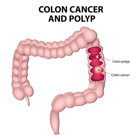 Colorectal Polyps in Singapore - Alpha Digestive & Liver Centre