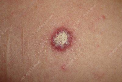 Discoid lupus erythematosus - Stock Image - C048/2903 - Science Photo Library