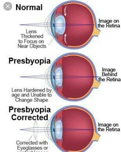 Lenses Correct Vision By Brainly - List two causes of presbyopia. Draw a labelled diagram of ...