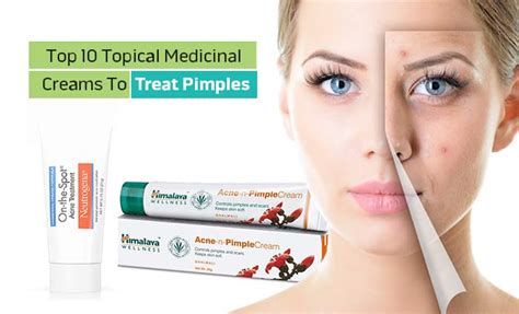 Top 10 Topical Medicinal Creams To Treat Pimples - Healthoduct