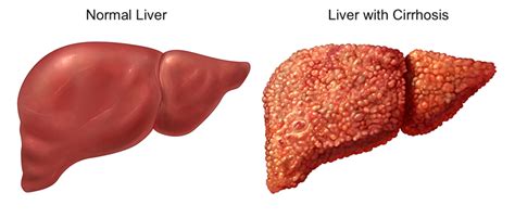 Hello USA: laennec's cirrhosis