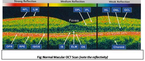 What is Optical Coherence Tomography (OCT)? Basic Interpretation ...