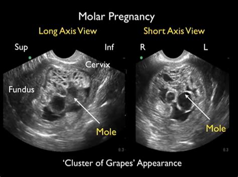 Molar Pregnancy: Diagnosis of Hydatidiform Mole Using Bedside Emergency Ultrasound — BROWN ...