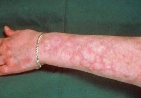 Livedo Reticularis (Mottling Skin) Causes, Pictures, Treatment