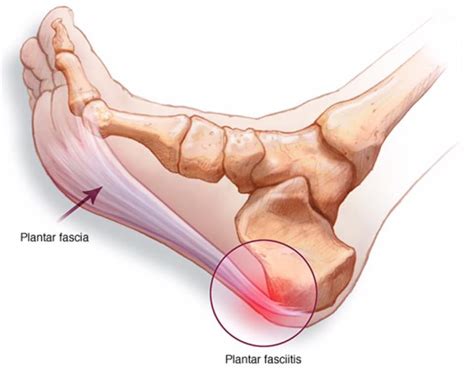 Plantar fasciitis – P-DTR® USA