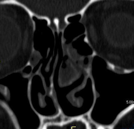 Mucocele and Pyocele of concha bullosa - Sumer's Radiology Blog