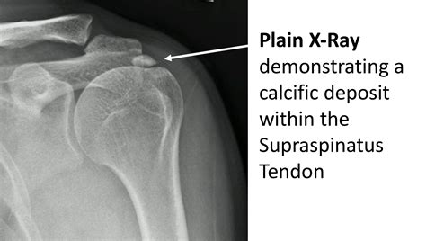 Shoulder Calcification