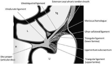 Ulnar Collateral Ligament Wrist Mri