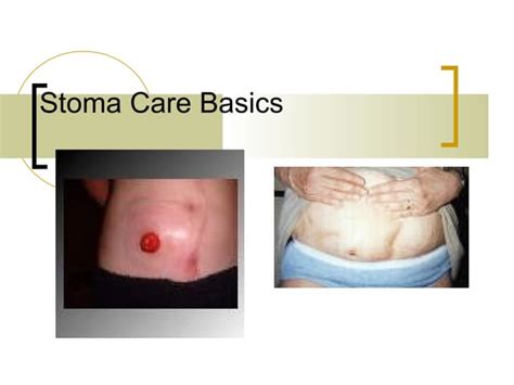 Stoma care basics n | PPT