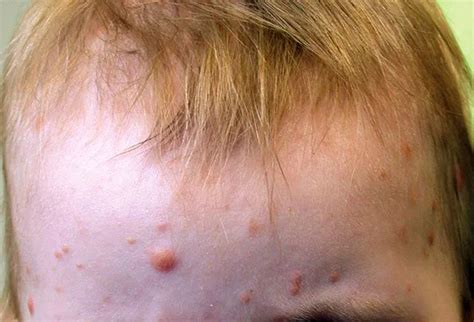 Picture of Skin Diseases and Problems – Juvenile Xanthogranuloma