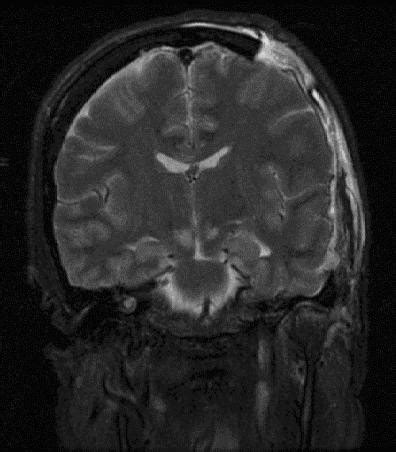 Intracranial pressure - wikidoc