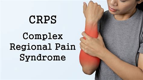 Complex Regional Pain Syndrome (CRPS) - YouTube