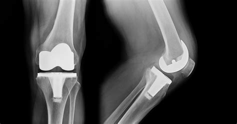 Total Knee Replacement Revision Surgery Nashville, TN | Orthopedic Surgery