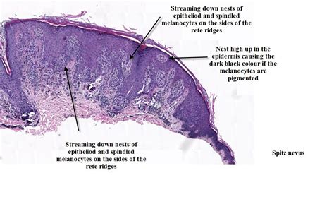 spitz nevus histology | Patologia