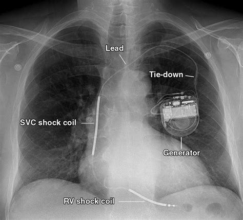 Ultrasound And Pacemakers at Brenda Cole blog