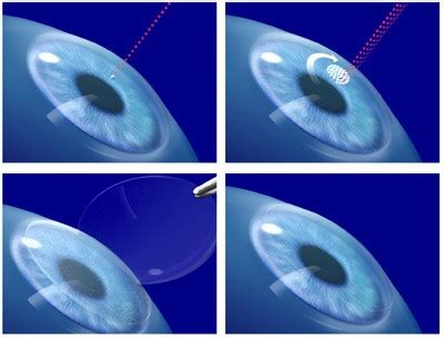 All Laser LASIK Castro Valley, CA - Eye Specialists San Jose, CA