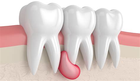 Abscess Tooth: What Is, Causes, Symptoms, and Treatment