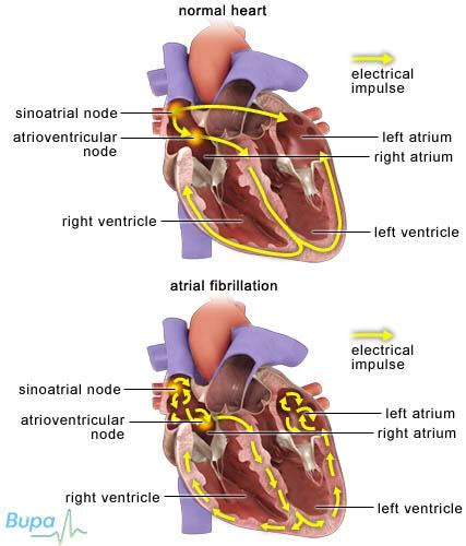 Atrial fibrillation