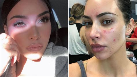 Kim Kardashian's Struggle with Psoriasis: Insights and Practical Advice