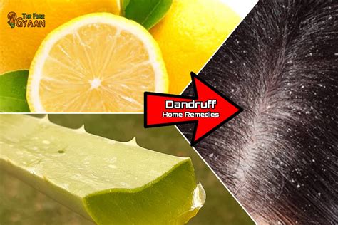 How to Get Rid Of Dandruff? | Dandruff Home Remedies | Its Treatment