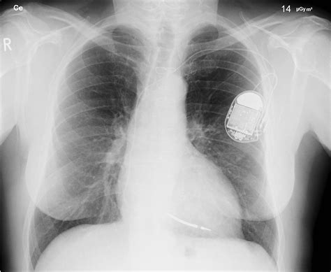 Artificial pacemaker - wikidoc