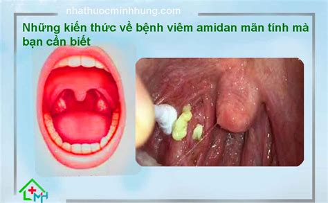 Những kiến thức về bệnh viêm amidan mãn tính mà bạn cần biết