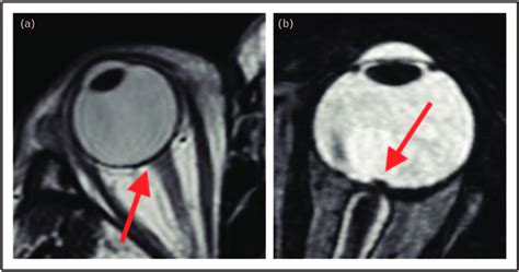 Occipital Nerve Mri